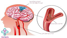 گرفتگی رگ های مغز